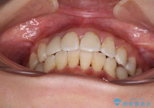 デコボコで磨きにくい前歯をスッキリと　インビザライン矯正の治療後
