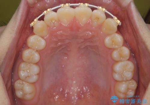 前歯のがたつき　部分矯正でコストダウンしながら、かみ合わせも治療の治療中