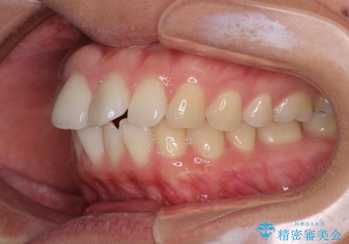前歯の出っ歯と口の閉じにくさが気になる 目立たないワイヤー装置での抜歯矯正の治療前