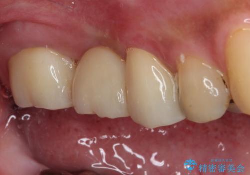 放置した奥歯の虫歯 セラミックブリッジによる補綴治療の治療後