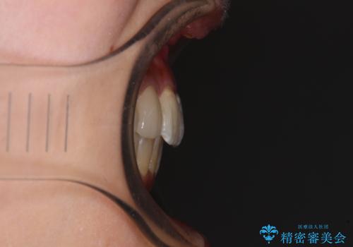 デコボコで磨きにくい前歯をスッキリと インビザライン矯正の治療後