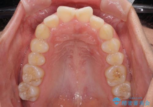 前歯の出っ歯と口の閉じにくさが気になる 目立たないワイヤー装置での抜歯矯正の治療前