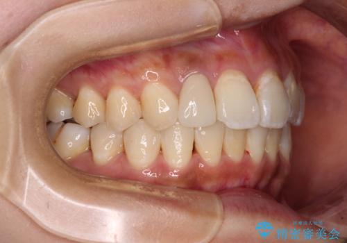 デコボコで磨きにくい前歯をスッキリと インビザライン矯正の治療後