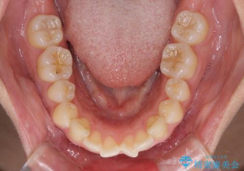 前歯の出っ歯と口の閉じにくさが気になる 目立たないワイヤー装置での抜歯矯正の治療前
