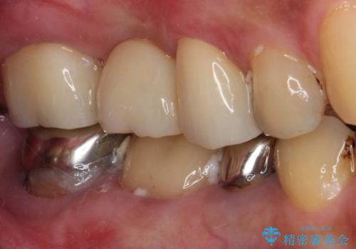 放置した奥歯の虫歯 セラミックブリッジによる補綴治療の治療後