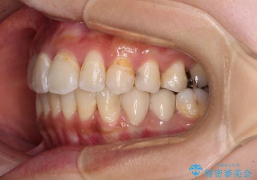 デコボコで磨きにくい前歯をスッキリと インビザライン矯正の治療後