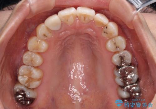 デコボコで磨きにくい前歯をスッキリと インビザライン矯正の治療後