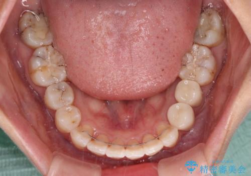 デコボコで磨きにくい前歯をスッキリと インビザライン矯正の治療後