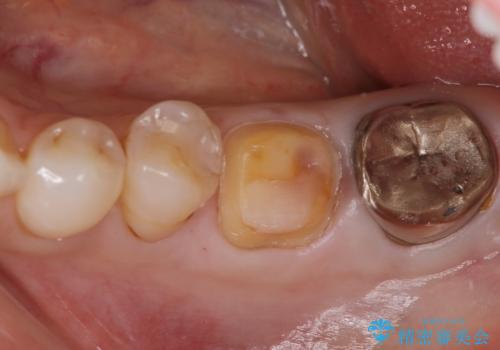 他院で仮歯までしたが、放置していたためセラミック入れたい セラミック治療の治療中