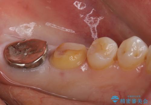 他院で仮歯までしたが、放置していたためセラミック入れたい セラミック治療の治療中