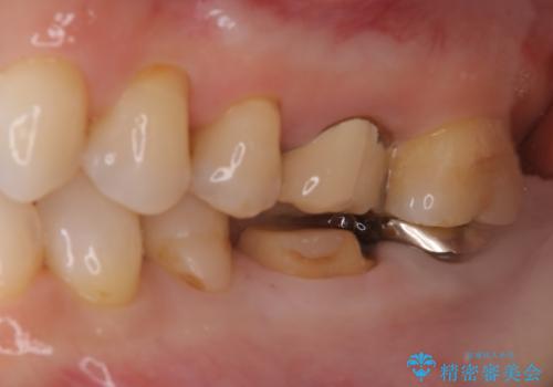 他院で仮歯までしたが、放置していたためセラミック入れたい セラミック治療の治療中