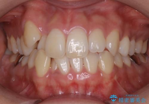 【非抜歯】インビザライン　隠れた前歯を並べる矯正治療の症例 治療前