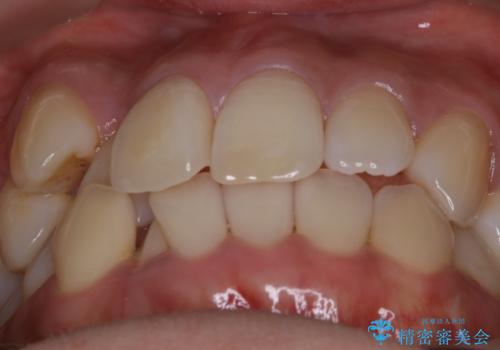 【非抜歯】インビザライン 隠れた前歯を並べる矯正治療の治療前