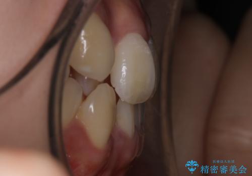 【非抜歯】インビザライン 隠れた前歯を並べる矯正治療の治療前