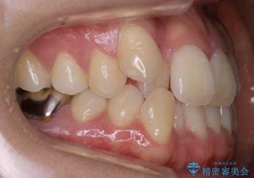 【非抜歯】インビザライン　隠れた前歯を並べる矯正治療の治療前