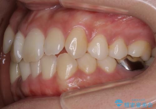 【非抜歯】インビザライン 隠れた前歯を並べる矯正治療の治療前