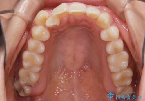 【非抜歯】インビザライン 隠れた前歯を並べる矯正治療の治療前