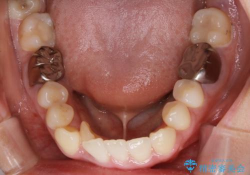 【非抜歯】インビザライン 隠れた前歯を並べる矯正治療の治療前