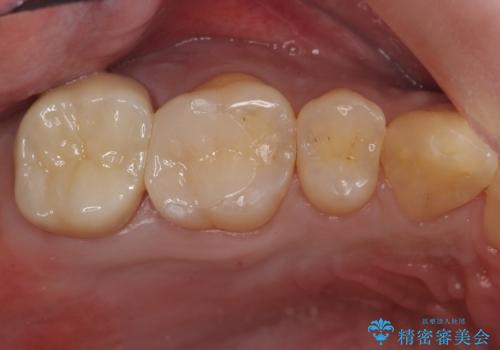 銀の詰め物を白い物にしたいの治療後