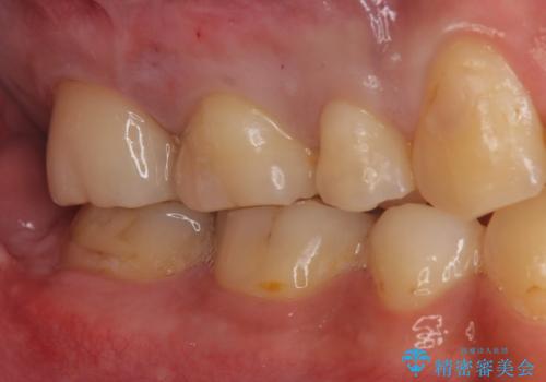 銀の詰め物を白い物にしたいの治療後