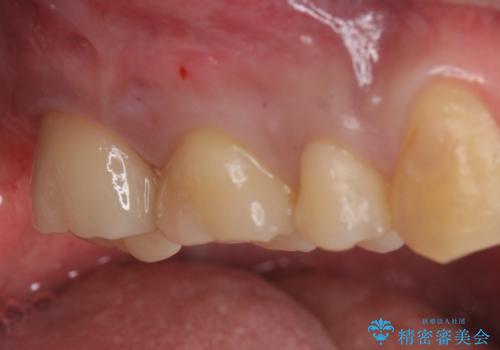 銀の詰め物を白い物にしたいの治療後
