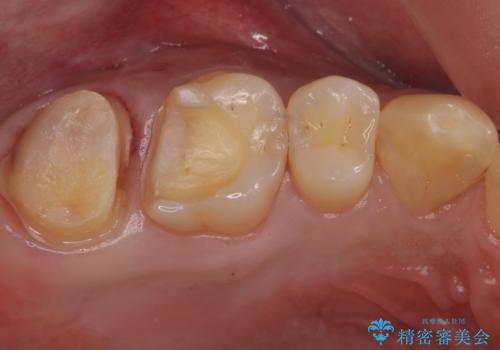 銀の詰め物を白い物にしたいの治療中