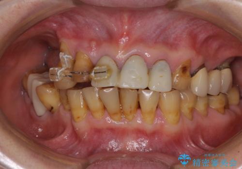 治療途中で放置してしまった前歯　オールセラミッククラウンによる補綴治療の症例 治療前