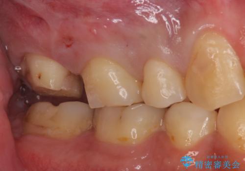 銀の詰め物を白い物にしたいの治療中