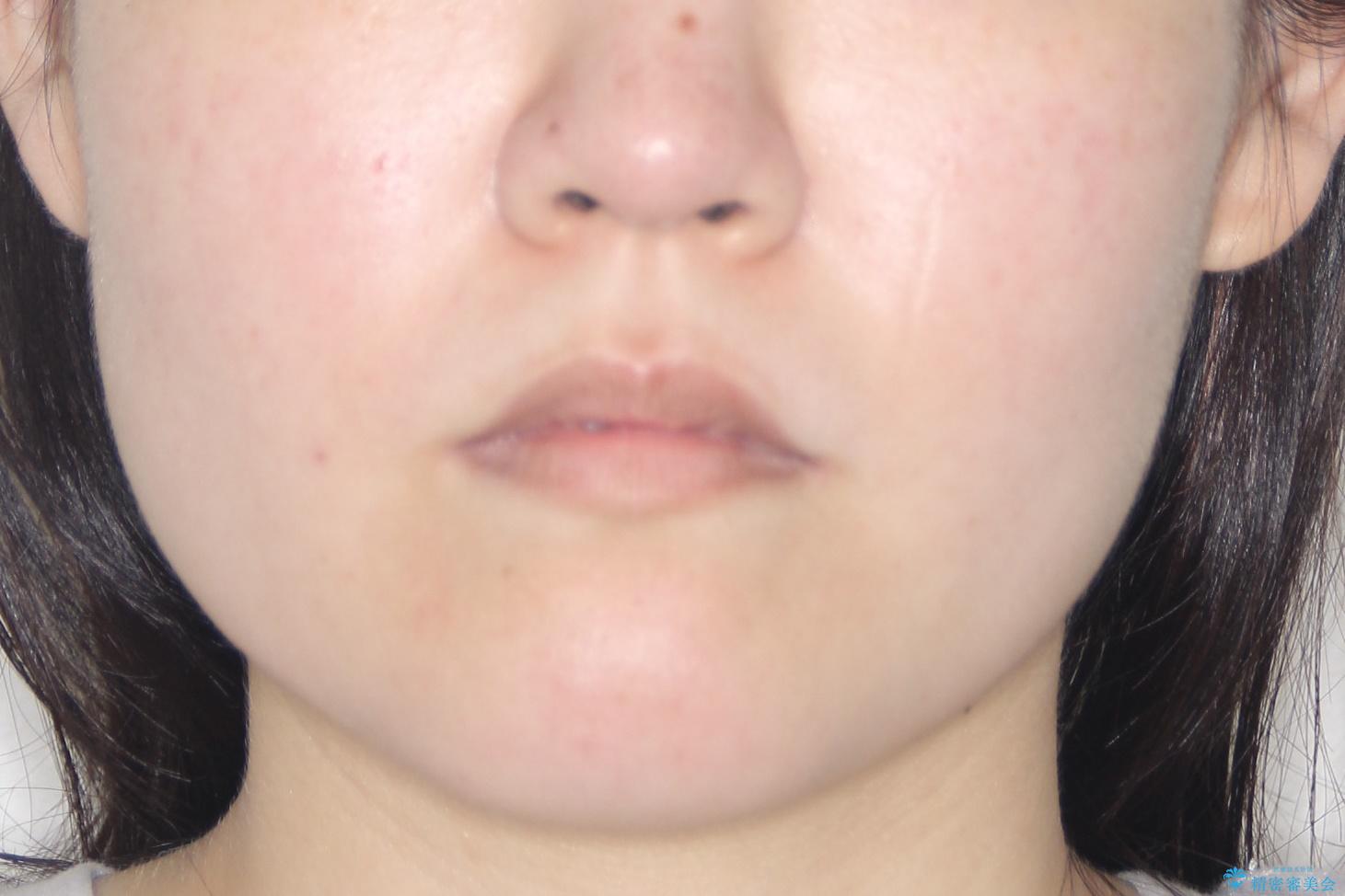 【引っ込んだ前歯が気になる、真ん中の線も揃えたい】インビザライン症例の治療前(顔貌)