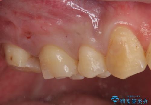 銀の詰め物を白い物にしたいの治療中