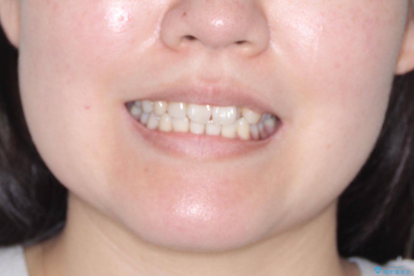 【引っ込んだ前歯が気になる、真ん中の線も揃えたい】インビザライン症例の治療前（顔貌）