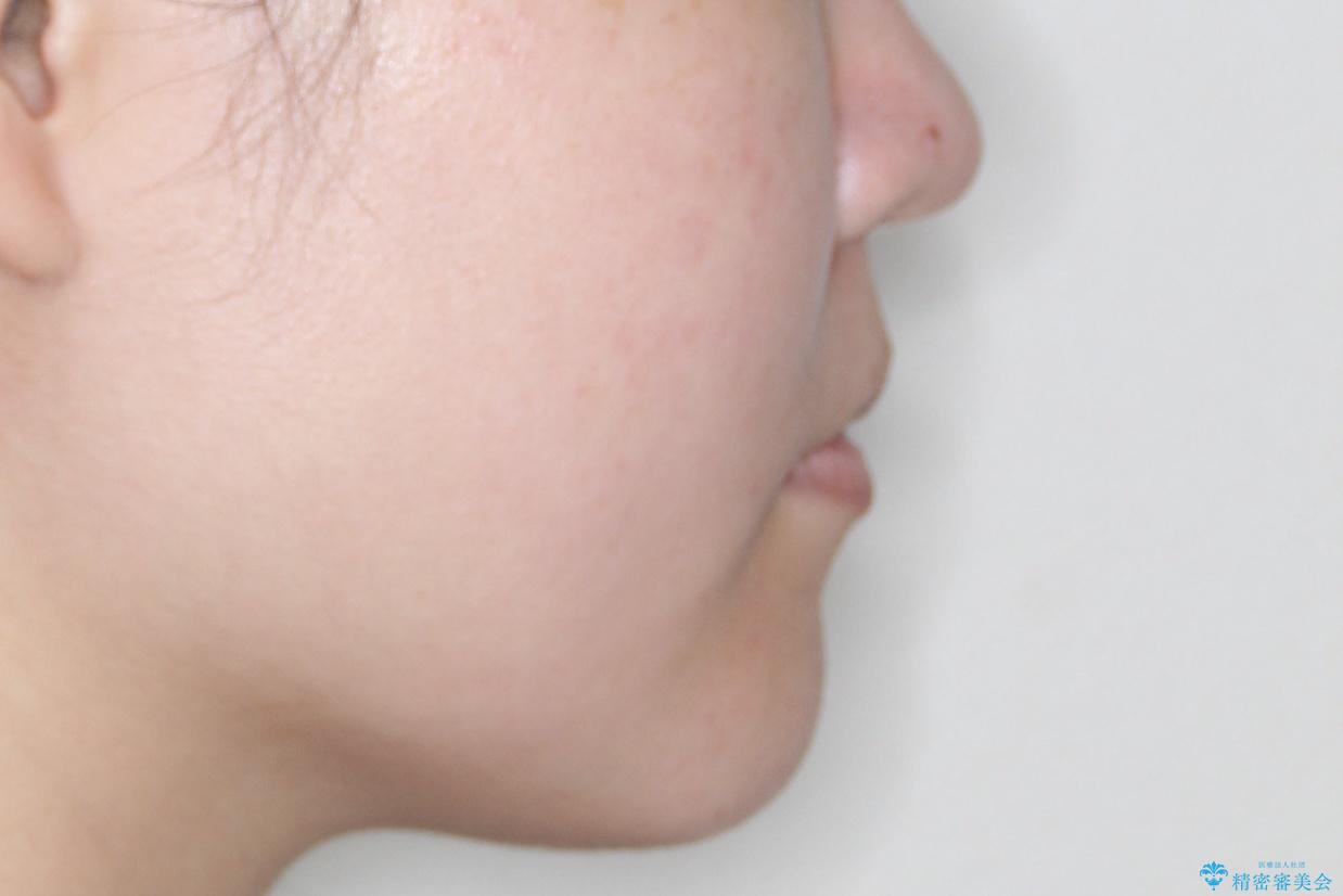 【引っ込んだ前歯が気になる、真ん中の線も揃えたい】インビザライン症例の治療前(顔貌)