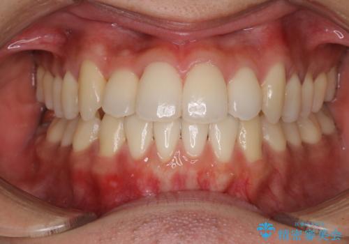 前歯が反対に咬んでいる　インビザラインによる矯正治療の症例 治療後