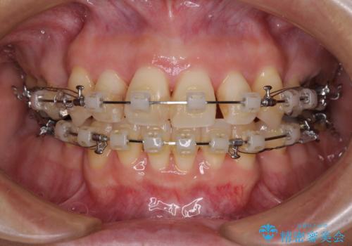 八重歯で口元が膨れている　ワイヤー装置での抜歯矯正の治療中
