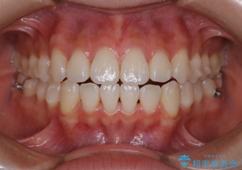 前歯で噛めない:オープンバイト(開咬)を非抜歯インビザラインで治療の治療中
