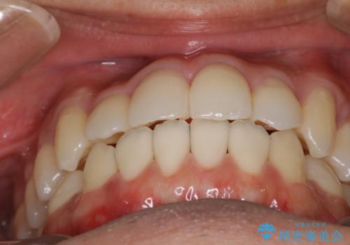 前歯が反対に咬んでいる インビザラインによる矯正治療の治療後