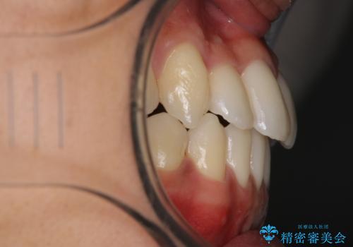 前歯が反対に咬んでいる　インビザラインによる矯正治療の治療後
