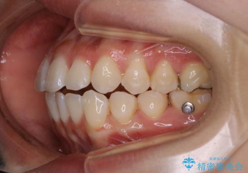前歯で噛めない:オープンバイト(開咬)を非抜歯インビザラインで治療の治療中