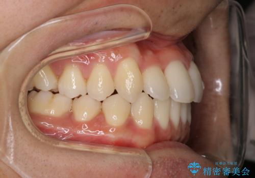 前歯が反対に咬んでいる インビザラインによる矯正治療の治療後