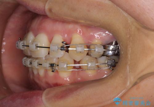 八重歯で口元が膨れている ワイヤー装置での抜歯矯正の治療中