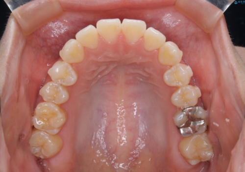 前歯で噛めない:オープンバイト(開咬)を非抜歯インビザラインで治療の治療中