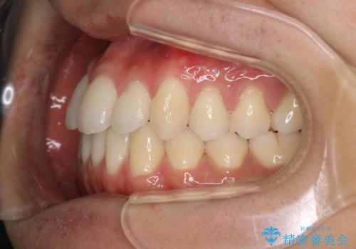 前歯が反対に咬んでいる インビザラインによる矯正治療の治療後