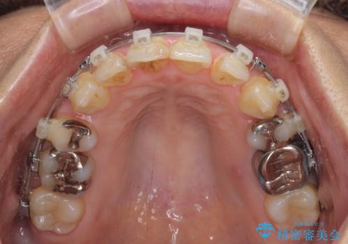 八重歯で口元が膨れている ワイヤー装置での抜歯矯正の治療中