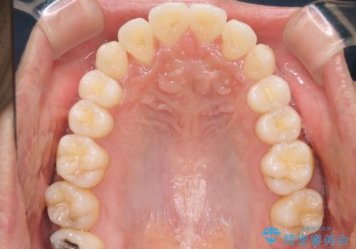 前歯が反対に咬んでいる　インビザラインによる矯正治療の治療後