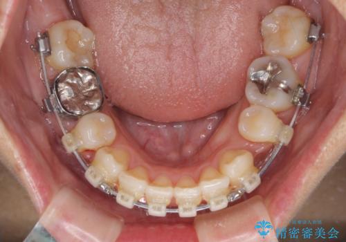 八重歯で口元が膨れている ワイヤー装置での抜歯矯正の治療中