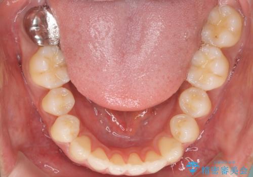 前歯が反対に咬んでいる インビザラインによる矯正治療の治療後