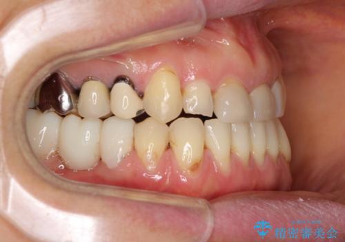 反対咬合や欠損を治療したい インビザライン矯正とオールセラミックブリッジの治療中