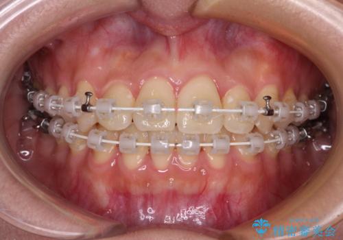 前歯のクロスバイトを短期間で解消 目立たないワイヤー矯正の治療中