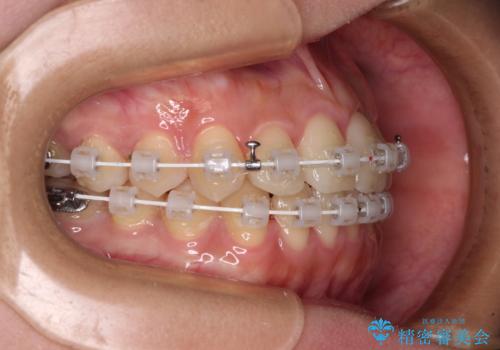 前歯のクロスバイトを短期間で解消 目立たないワイヤー矯正の治療中
