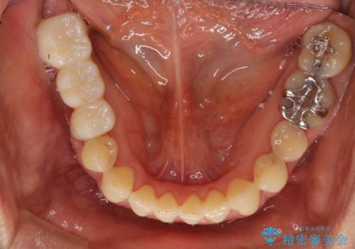 反対咬合や欠損を治療したい インビザライン矯正とオールセラミックブリッジの治療中